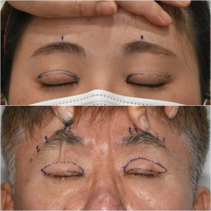 compare double eyelid surgery and upper blepharoplasty