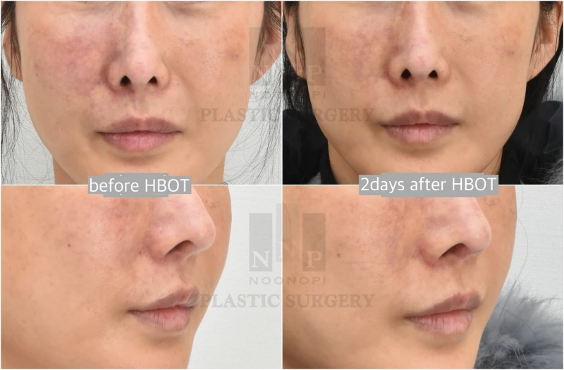 韩国填充剂副作用治疗