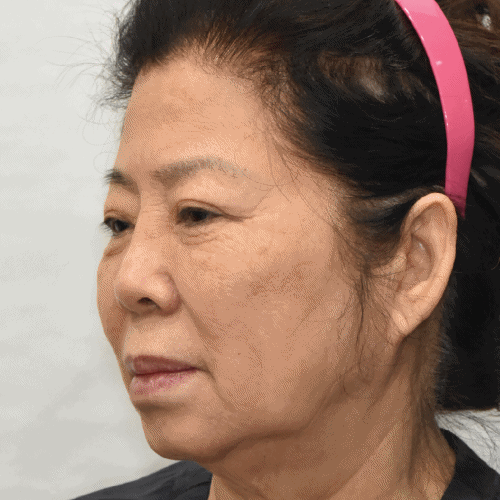 面颈部提升术:术后2个月