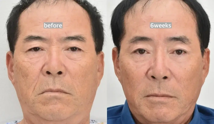 内路额部提升术(适用于脱发人群)