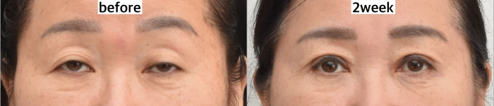 Asymmetric Eye Surgery Pre and postoperative Photo