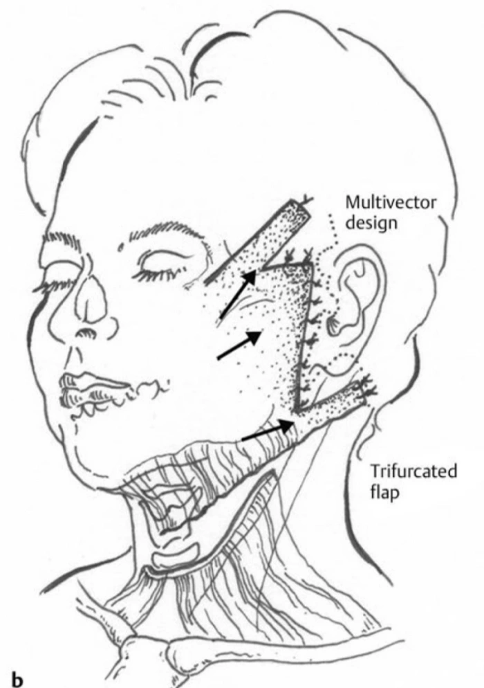 SMAS组织可多方向牵引（参考链接）
