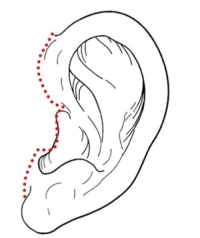 posterior tragus incision in facelift