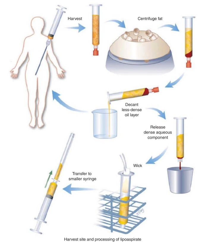 facial fat graft process