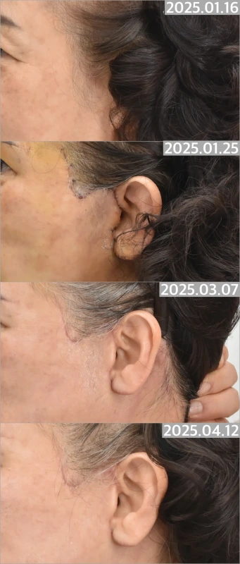 ندبة أقل وضوحًا مع سوالف وشحمة أذن وغضروف تراجي طبيعي المظهر