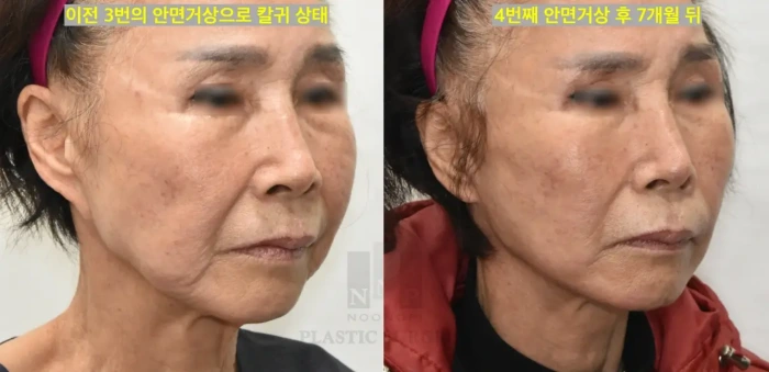 안면거상 재수술로 칼귀 교정한 사례