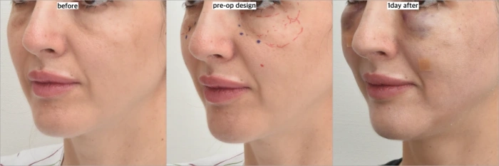 حقن الدهون في وقت مبكر بعد العملية