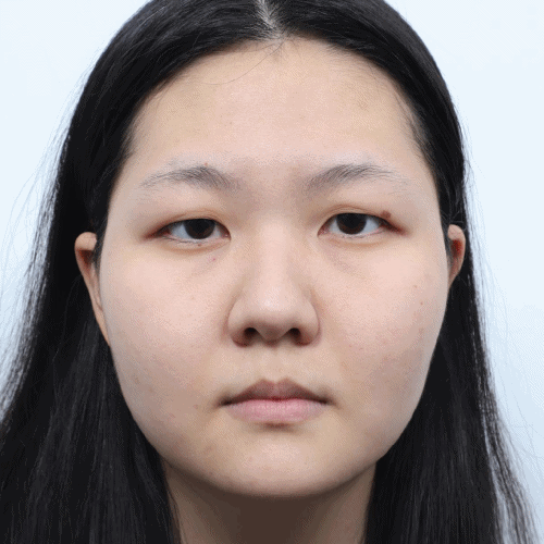 눈매교정 전후