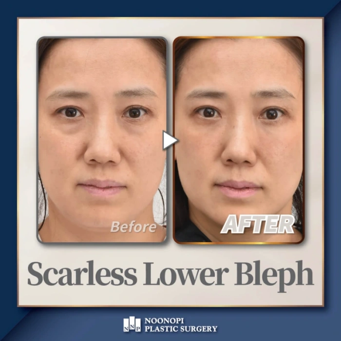 无皮肤切口下睑成形术案例