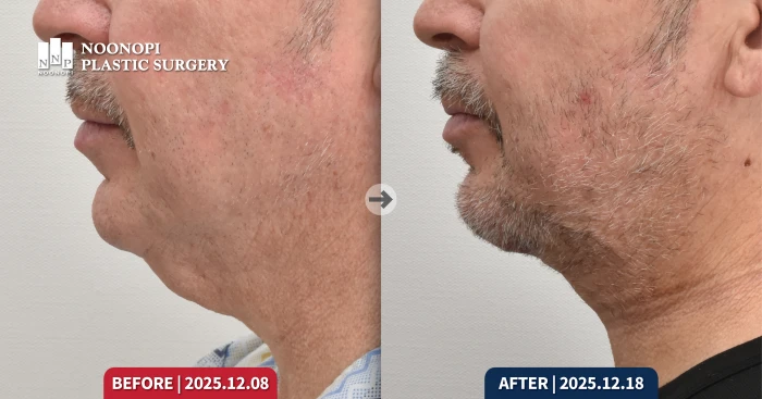 Before and after side profile of a male mini neck lift patient at Noonopi Plastic Surgery Korea