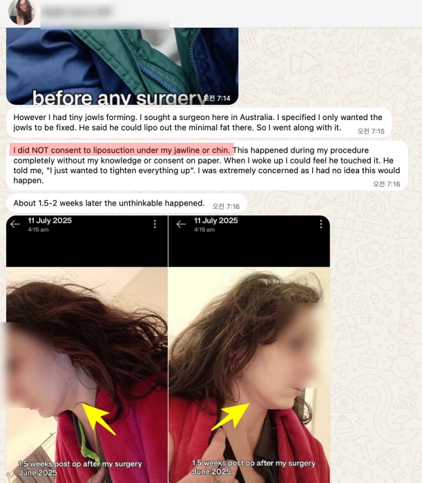 Complication Case from Improper Liposuction