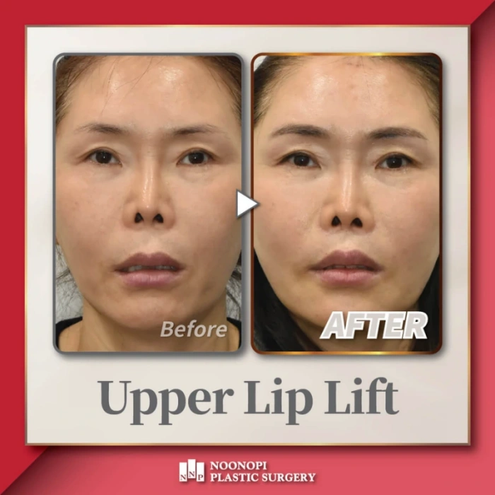 حالة شد الشفة العليا.