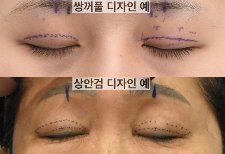 تجميل الجفن العلوي المتقدم في السن