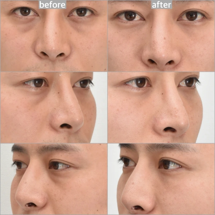 صورة بعد الجراحة: جراحة الجفن السفلي بدون ندبات، زراعة الدهون النانوية، ليزر BBL