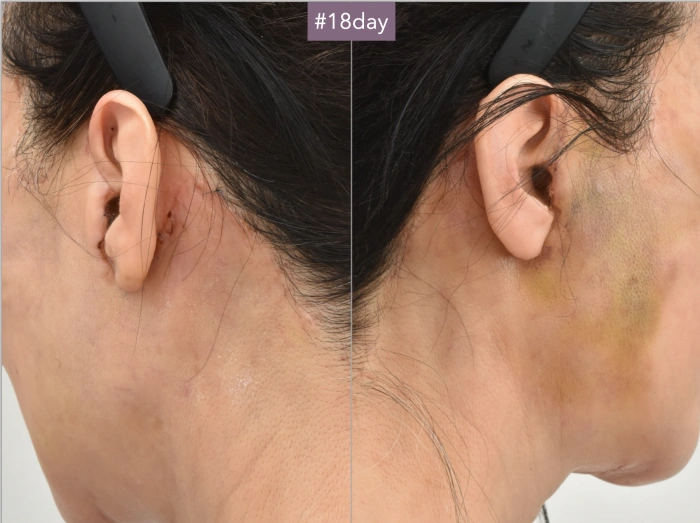 behind ear scar after facelift