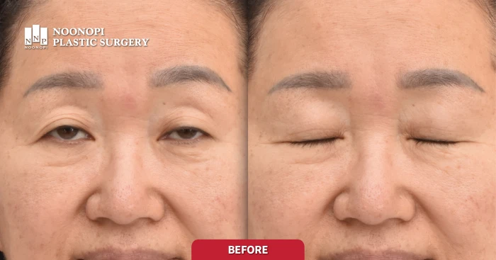 Pre-operative evaluation of a 60-year-old patient with uneven eyes