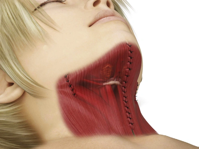 颈部束带式颈阔肌成形术示意图