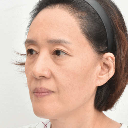 صورة قبل وبعد عملية حقن الدهون في الوجه