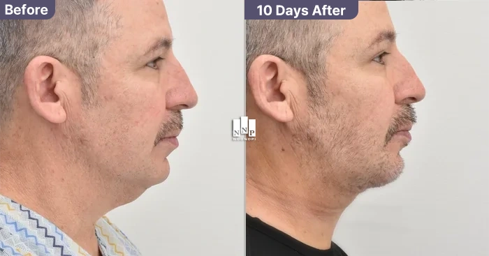 Caucasian mini neck lift for neck skin redundancy