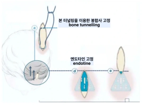 Endotine مقابل التثبيت بالخياطة لرفع الحاجب