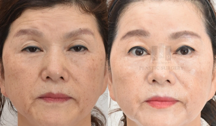 眼睑下垂矫正联合提眉术术前术后对比