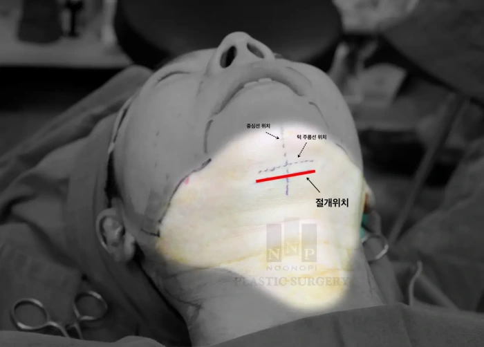 목거상 절개 위치