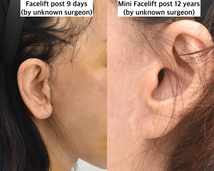 facelift scars in front of the ear