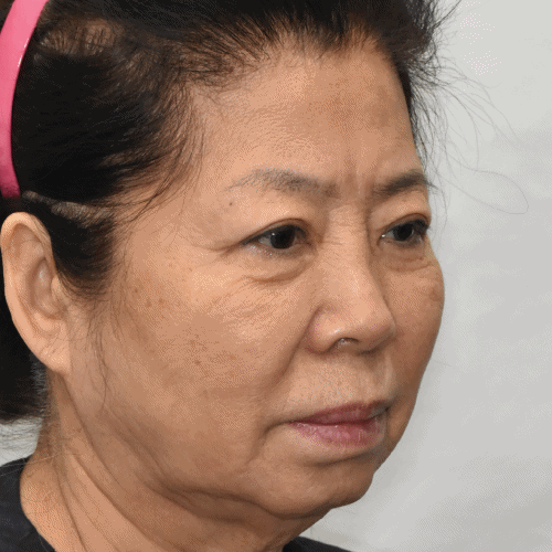 Face and neck lift: before and after 2 months