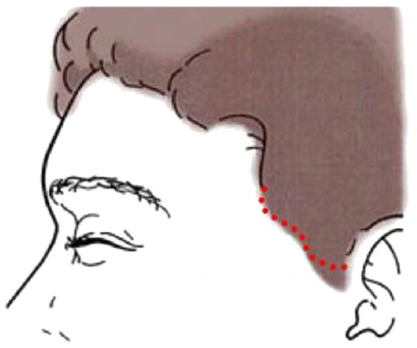 Hairline incision placement comparison