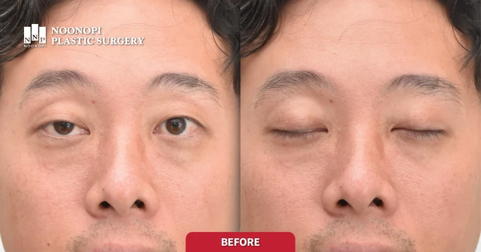 Male patient with sleepy eyes and forehead wrinkles caused by ptosis