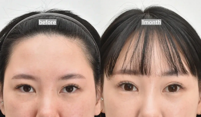 韩国额头提升术前后对比