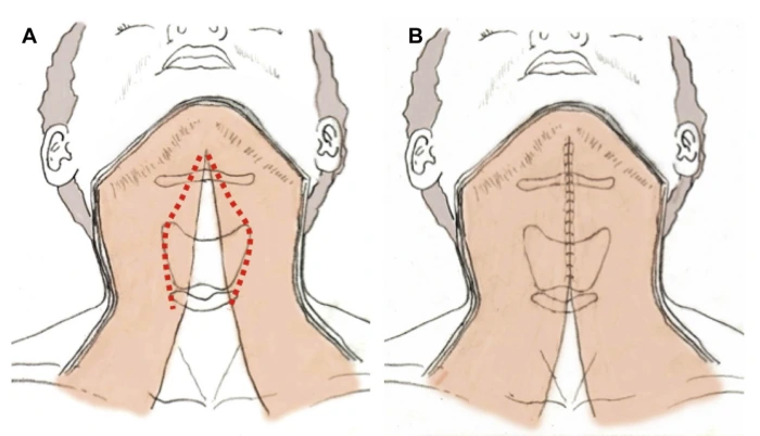 Platysmaplasty Illustration