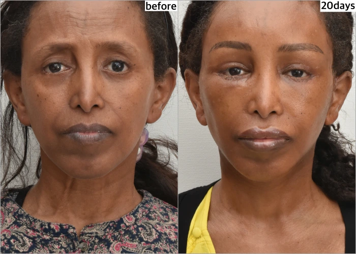 Early Facelift Results in Korea — Post Op Day 19