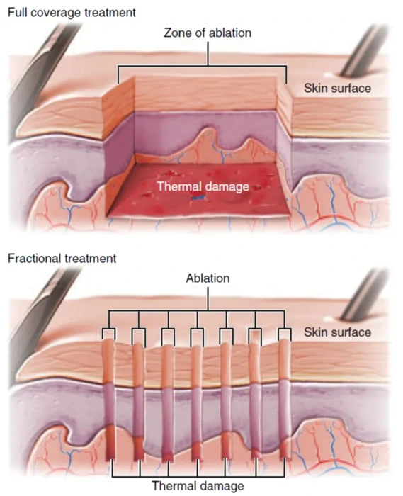 fractional vs full ablative