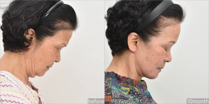 Photo of a patient after neck lift surgery. The neck is sharp, even with the head tilted down