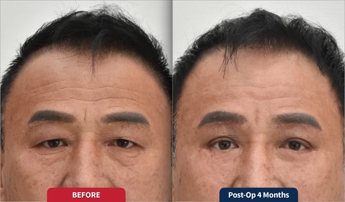 Complete resolution of PIH over time