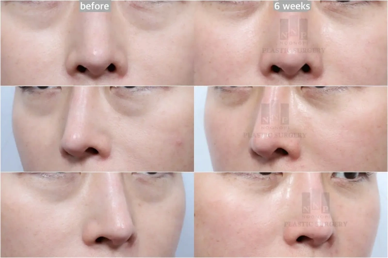 lower eyelid fat repositioning before after