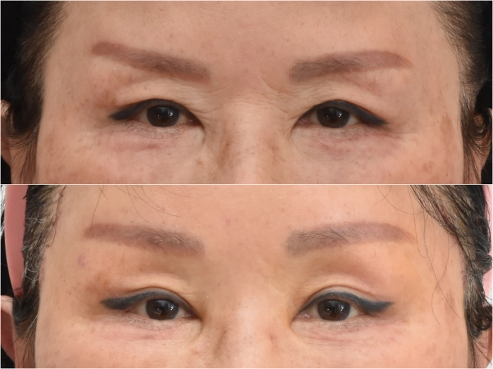 Before and after endoscopic brow lift improving a strong impression