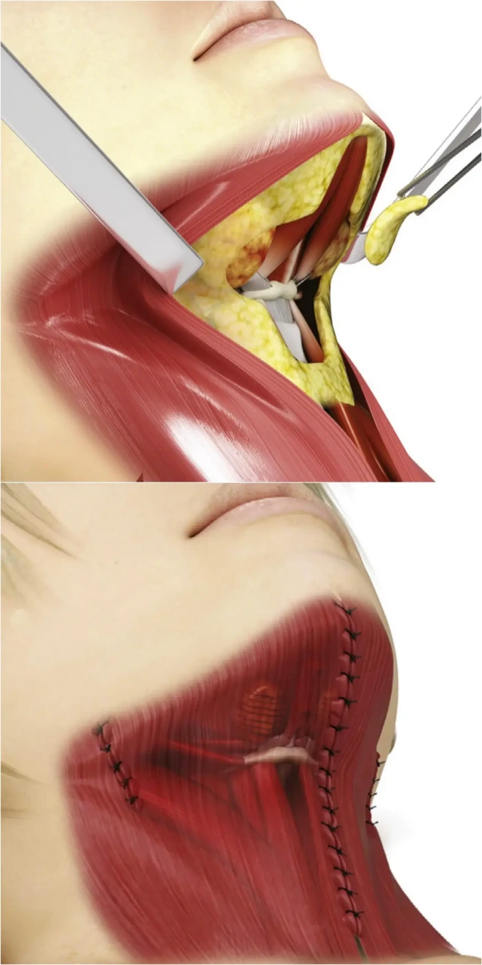 double chin surgery via neck lift