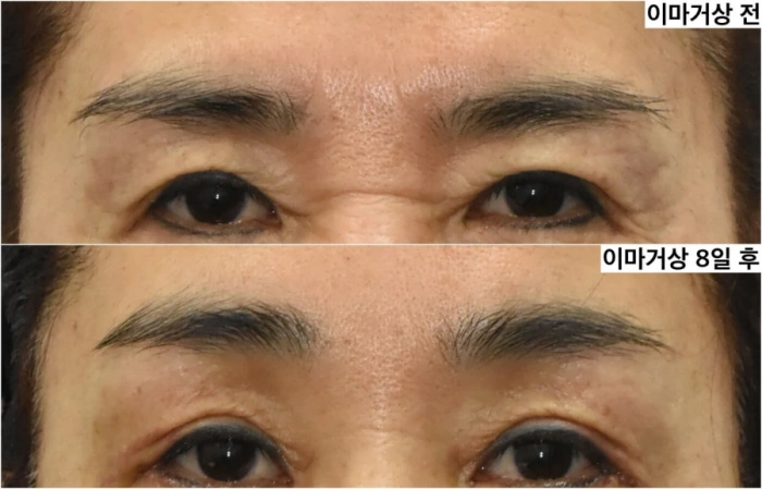 endoscopic forehead lift before after