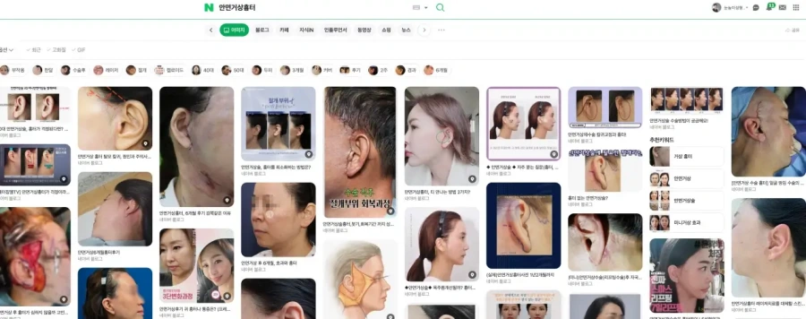 부자연스러운 흉터가 남은 안면거상 수술 사례