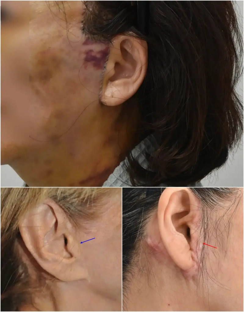 耳屏可见疤痕