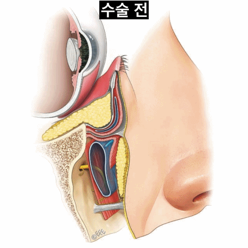 눈밑지방재배치 과정