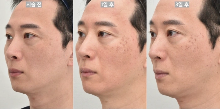 포에버영 시행 후 경과모습