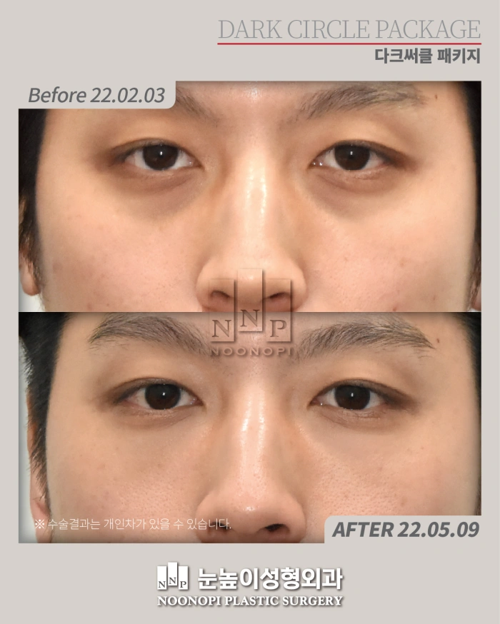 经结膜下眼睑手术+纳米脂肪移植治疗黑眼圈；术前术后对比