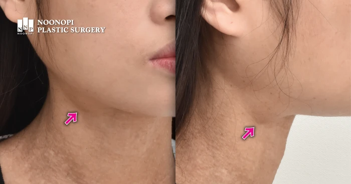 Anatomy of salivary glands in the human face