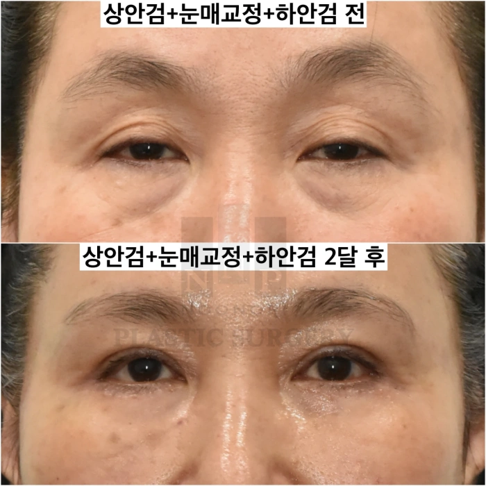 상안검 눈매교정 하안검 전후 모습