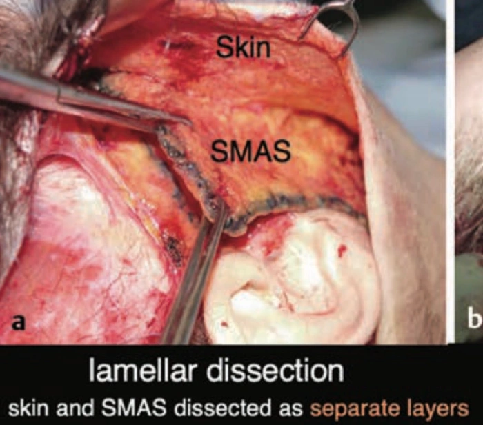 双层分离术（参考链接）