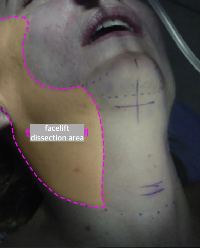 facelift dissection area