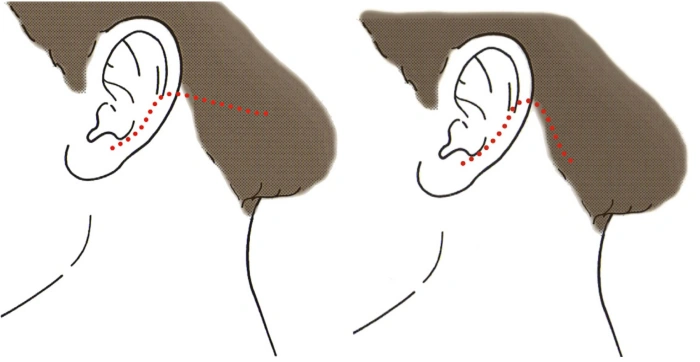 نوعان من الشقوق خلف الأذن: داخل خط الشعر أو على طوله